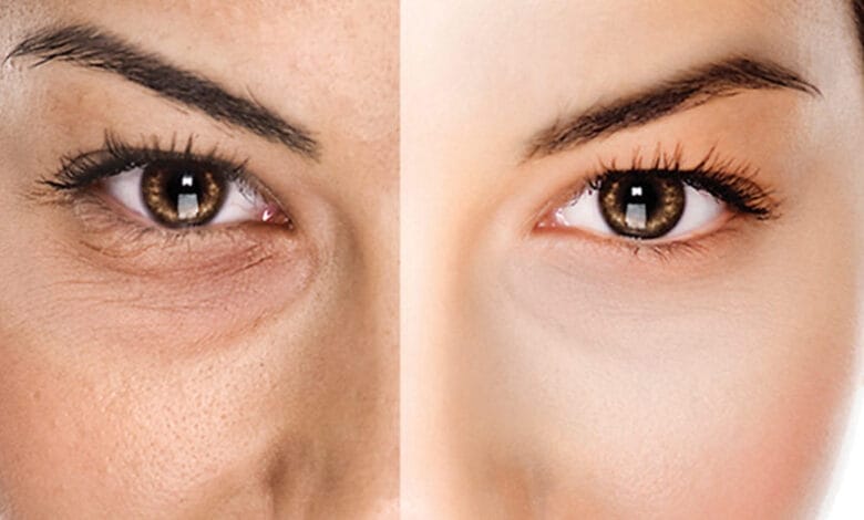 مشكلة الهالات السوداء تحت العين