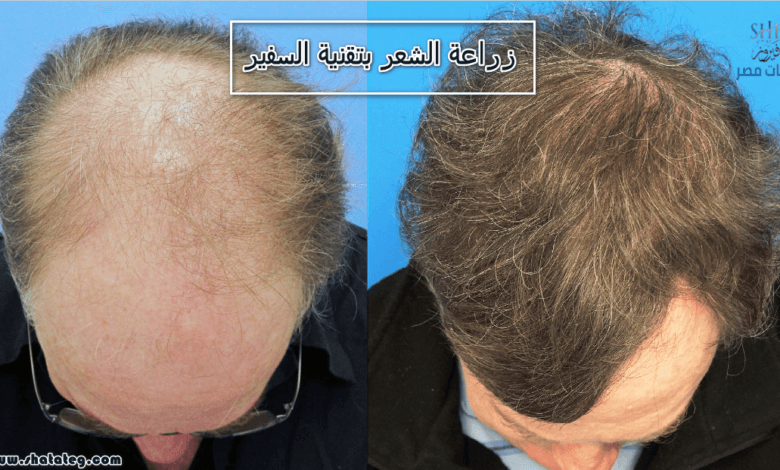 زراعة الشعر بتقنية السفير