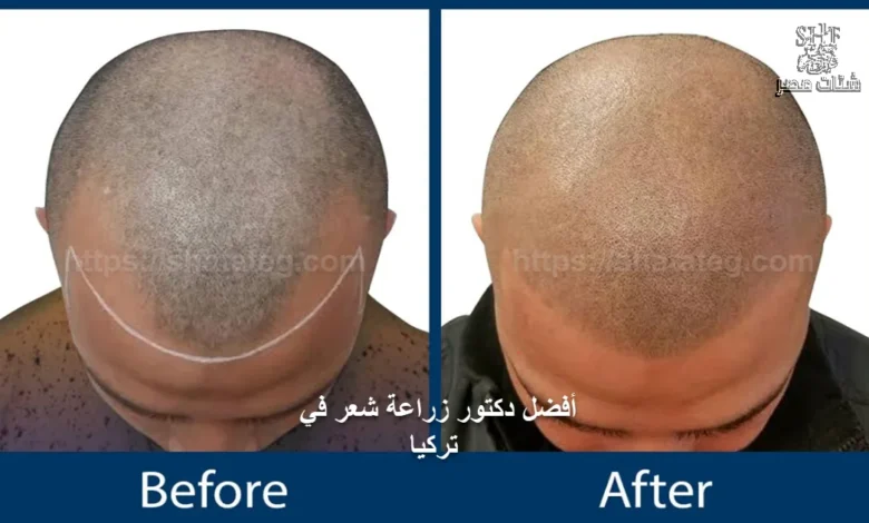 افضل دكتور زراعة شعر في تركيا