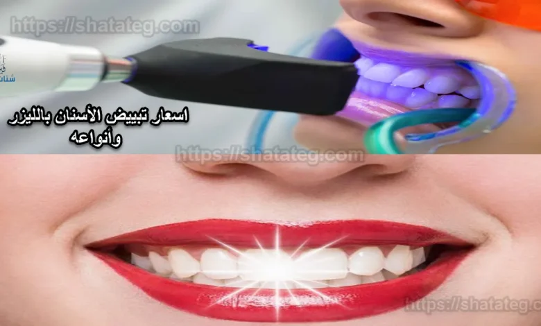 اسعار تبييض الأسنان بالليزر
