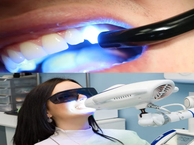 الفرق بين تبييض الأسنان بالزوم والبلازما