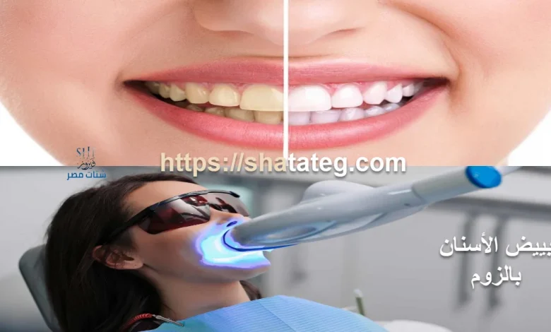تبييض الأسنان بالزوم
