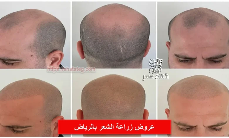 عروض زراعة الشعر بالرياض