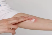 افضل كريم للحساسيه والحكه
