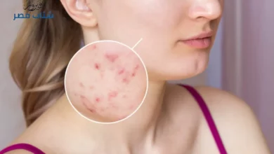 علاج حب الشباب