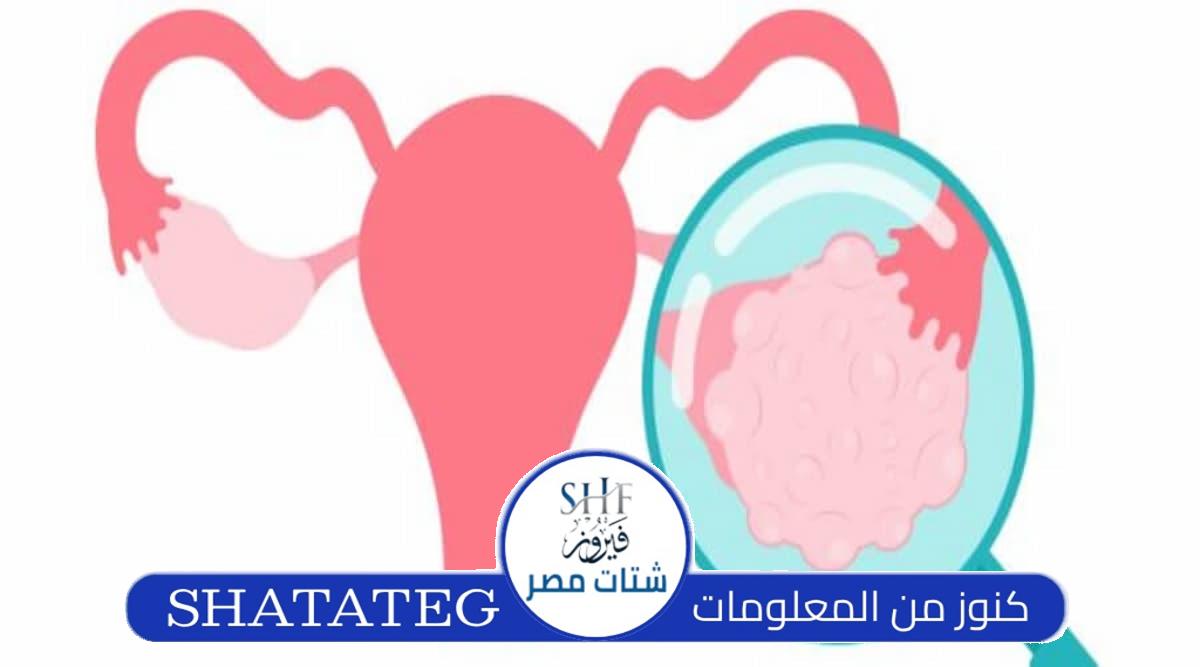 أعراض التكيس وقت الدورة