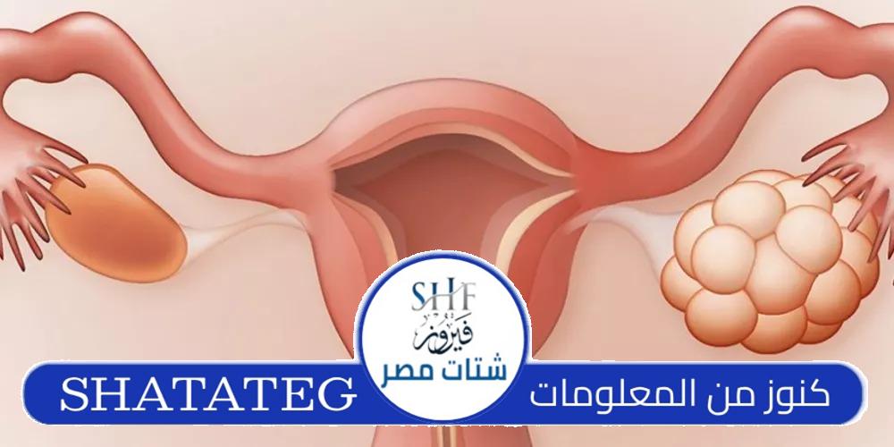 أعراض التكيس وقت الدورة