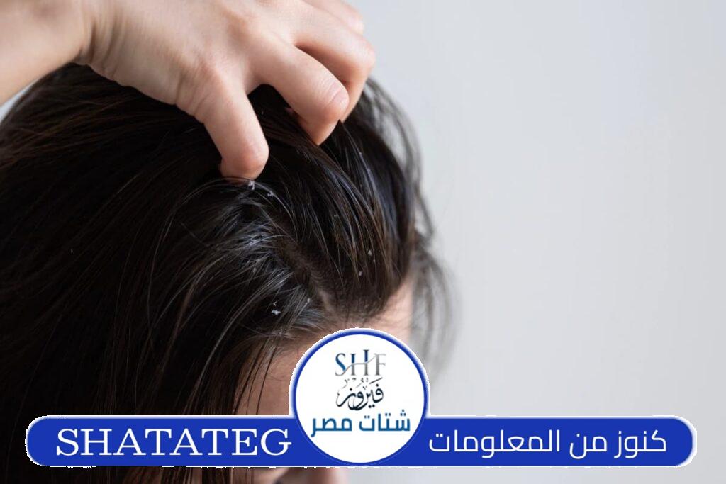 علاج قشرة الشعر