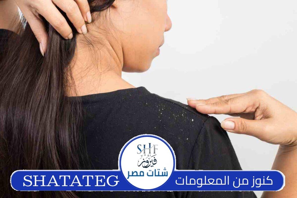 علاج قشرة الشعر