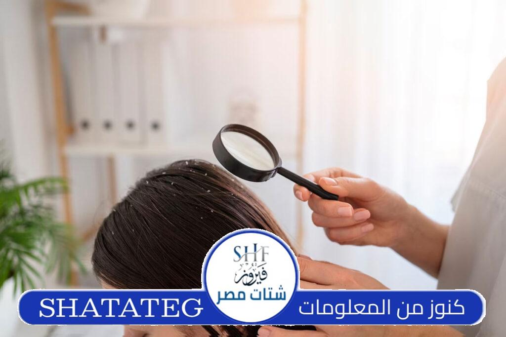 علاج قشرة الشعر